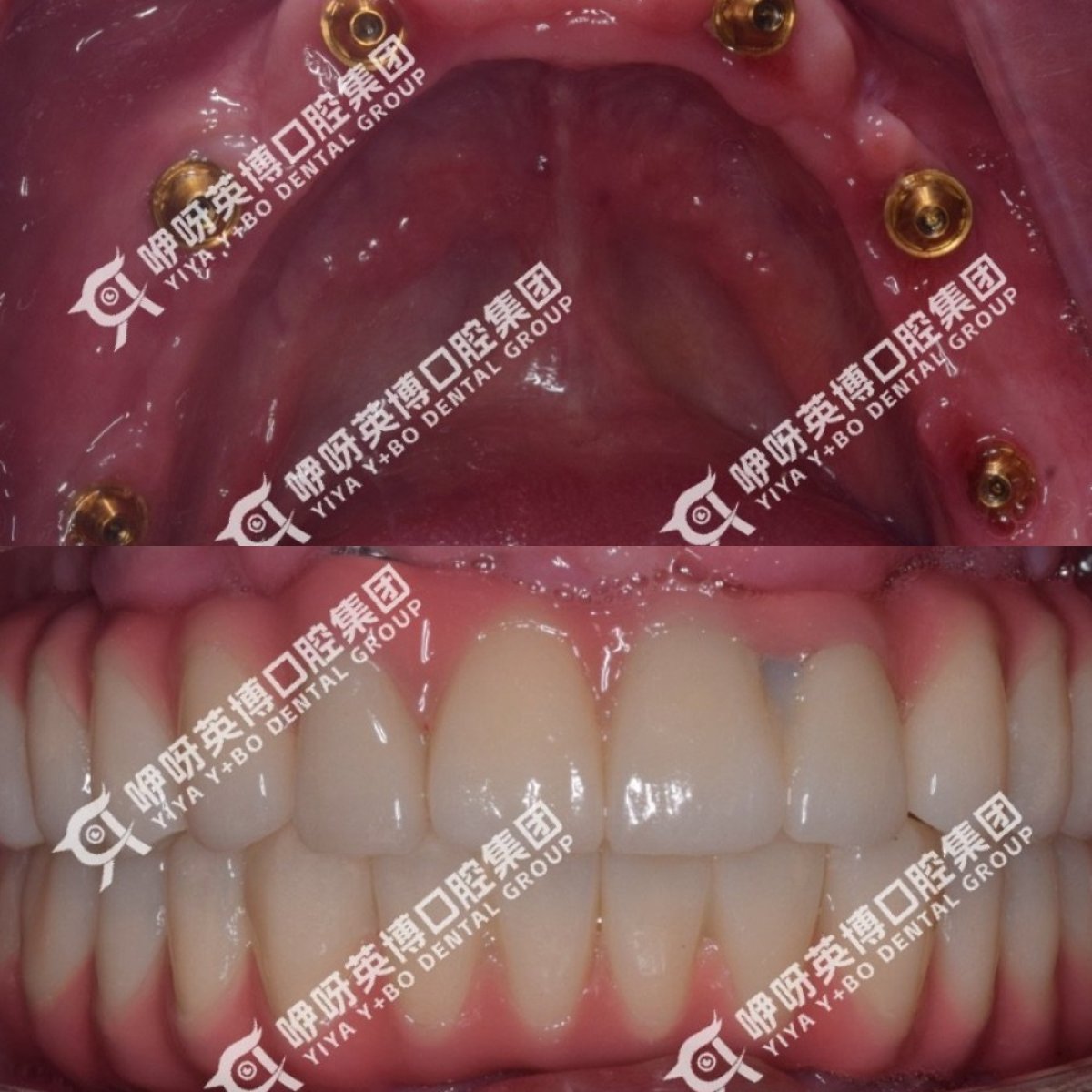 Immediate All-on-4 dental implants before and after results at Shanghai Y+bo Dental Clinic