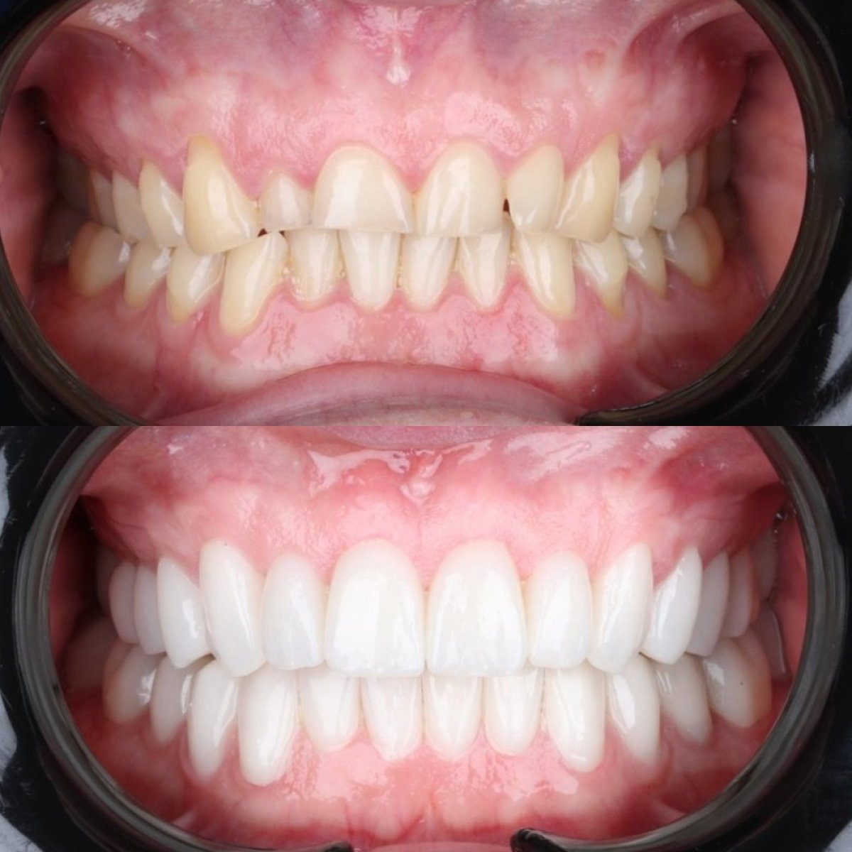 قبل وبعد الفينير في عيادة D'art Dental Clinic – تحول الابتسامة ونتيجة أسنان أكثر بياضًا