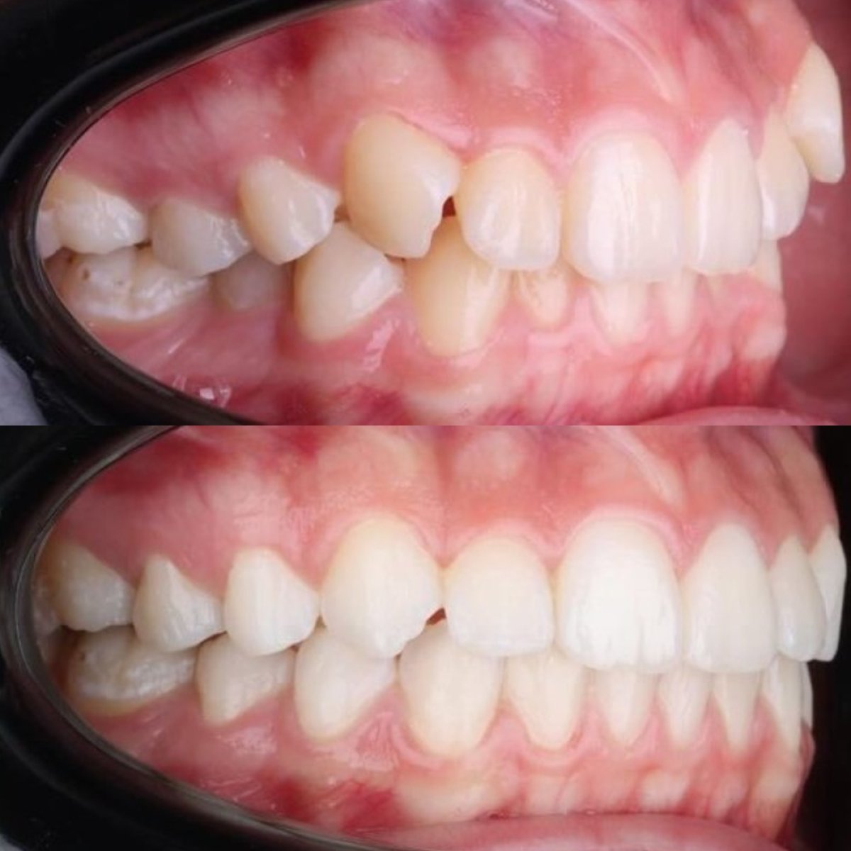 Resultados de antes y después de Invisalign en D'art Dental Clinic – mejora de alineación dental