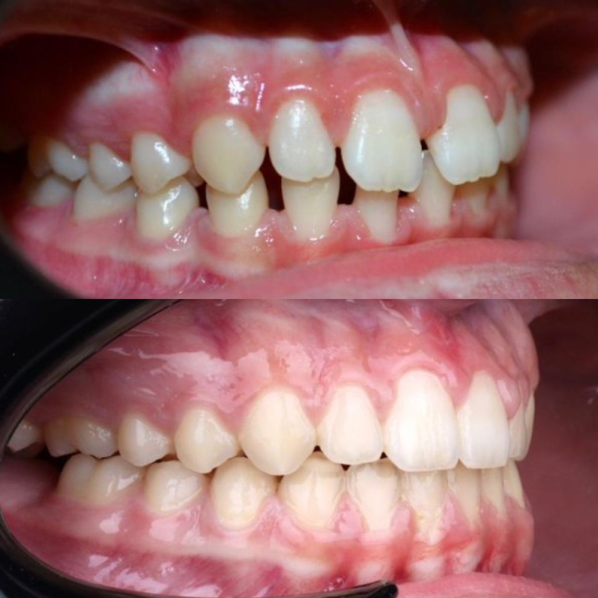 Resultados de antes y después de Invisalign en D'art Dental Clinic: alineación dental mejorada