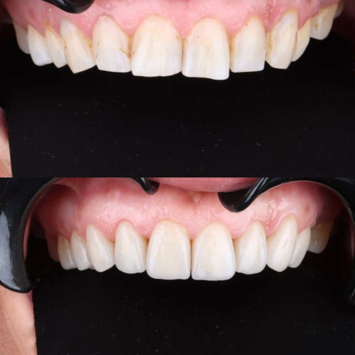 До и после установки виниров в D'art Dental Clinic – улучшение улыбки и белизны зубов