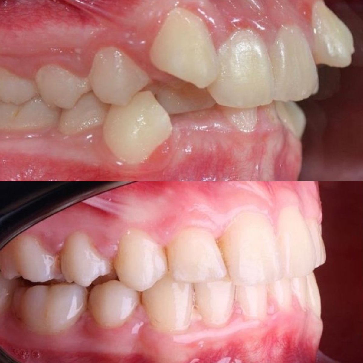 Resultados de antes y después de Invisalign en D'art Dental Clinic – mejora de alineación dental