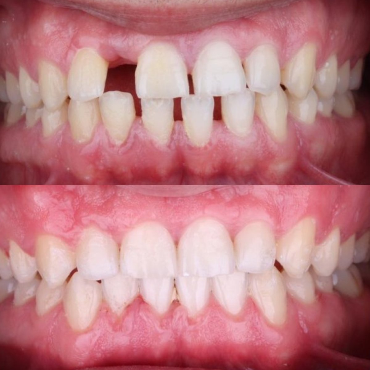 Resultados de antes y después de Invisalign en D'art Dental Clinic: alineación y cierre de espacios