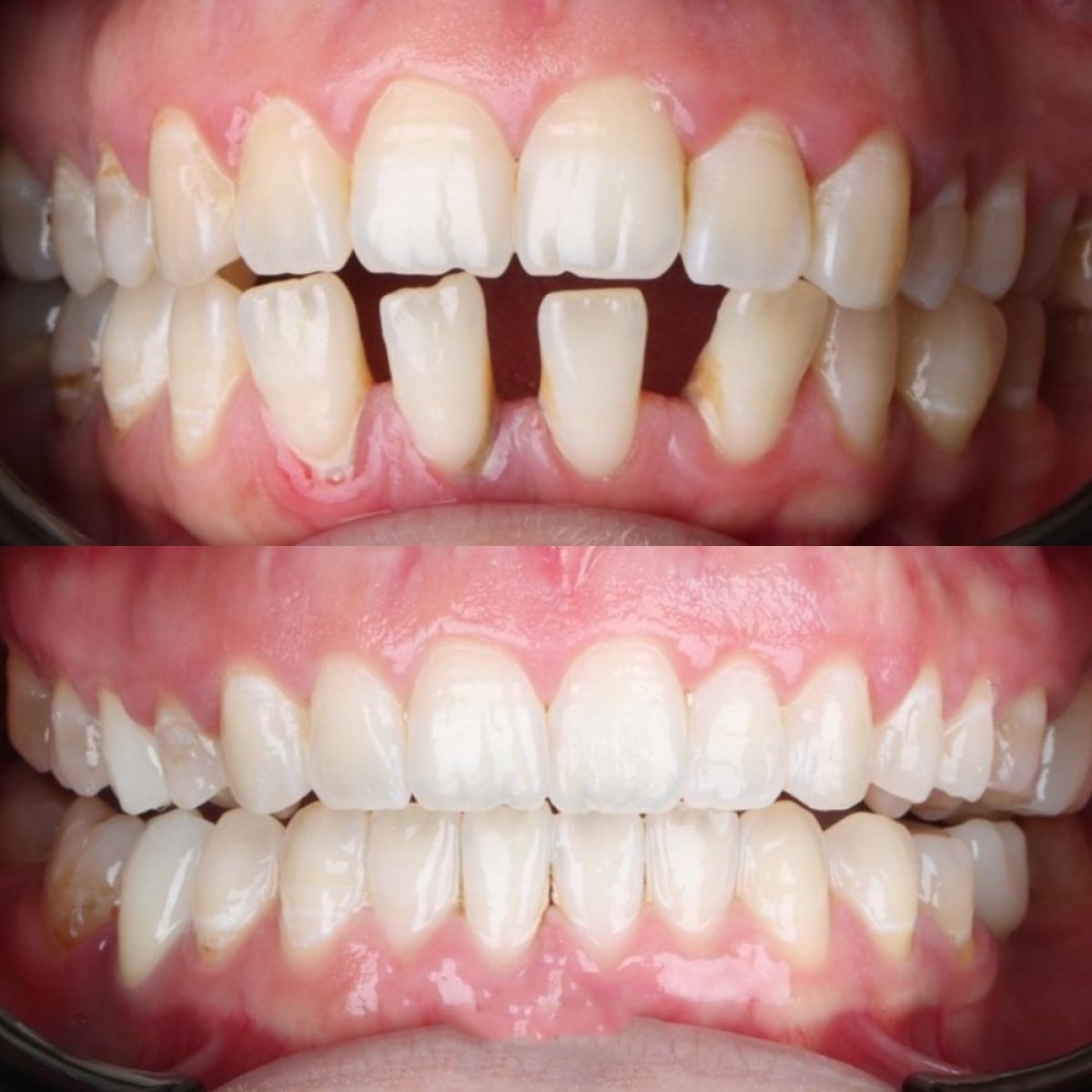 Resultados antes y después de Invisalign en D'art Dental Clinic – mejora de alineación dental