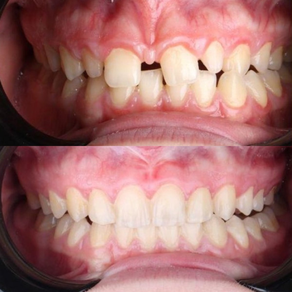 Resultados antes y después de Invisalign en D'art Dental Clinic, mejora de alineación dental