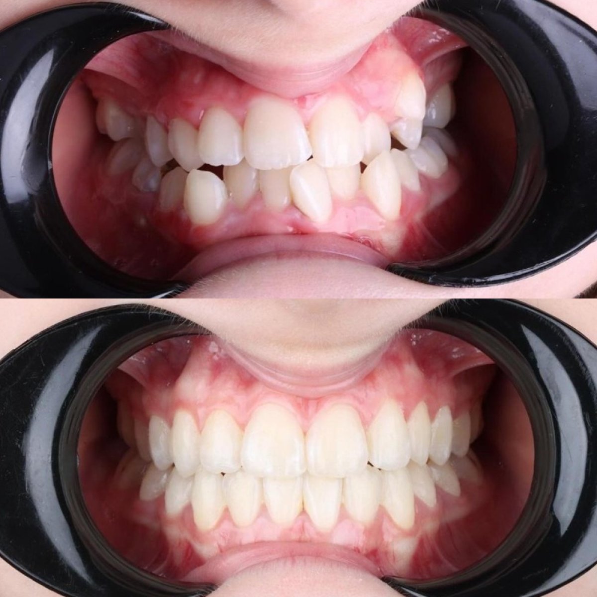 Before and after Invisalign results at D'art Dental Clinic – improved teeth alignment and smile