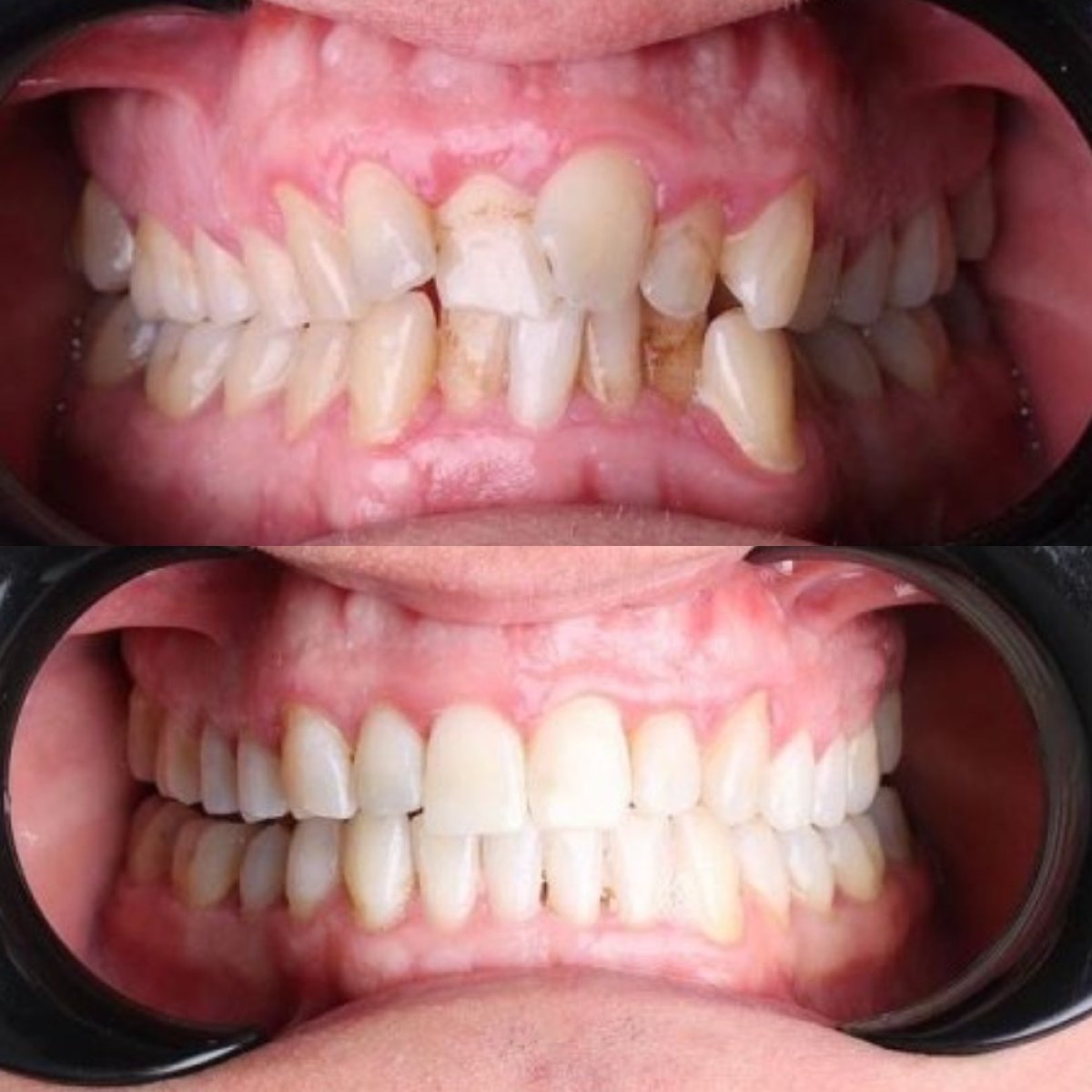 Resultados antes y después de Invisalign en D'art Dental Clinic: dientes más rectos y blancos