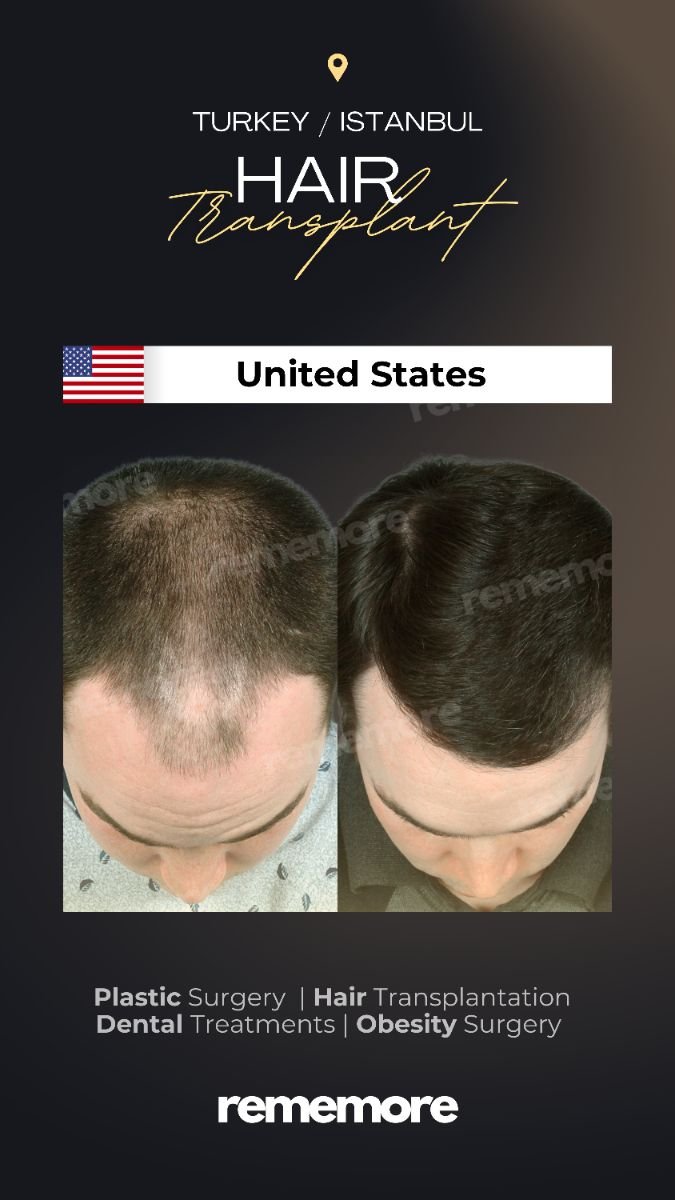 Before and after hair transplant results at Memorial Bahçelievler Hospital, fuller hairline