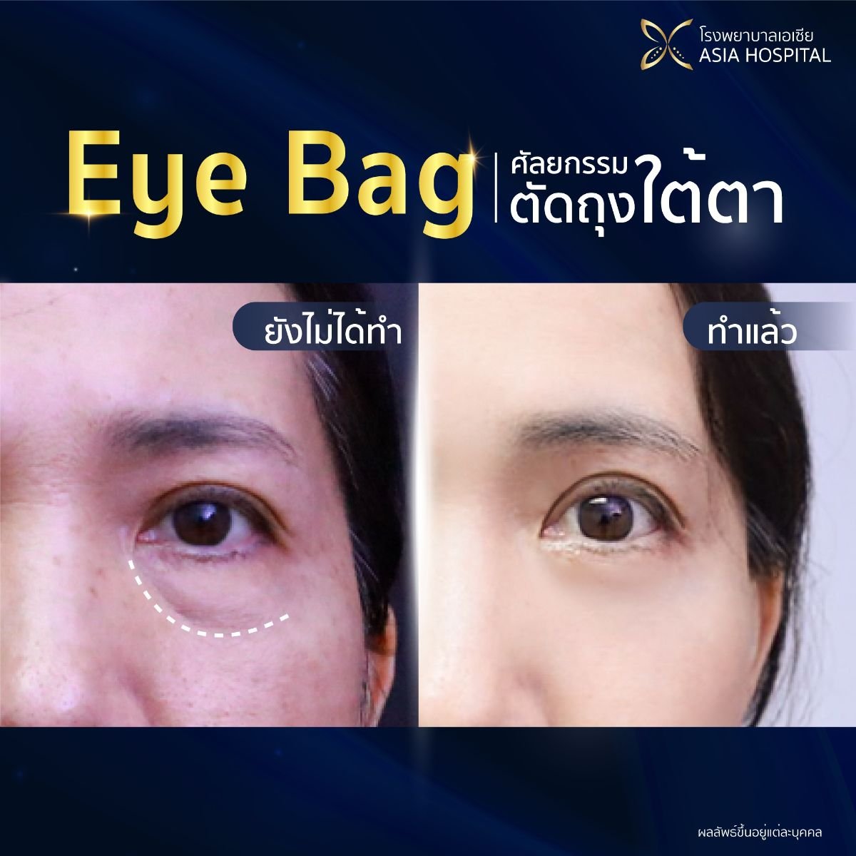 Before and after blepharoplasty results at Asia Cosmetic Hospital, eye bag removal procedure