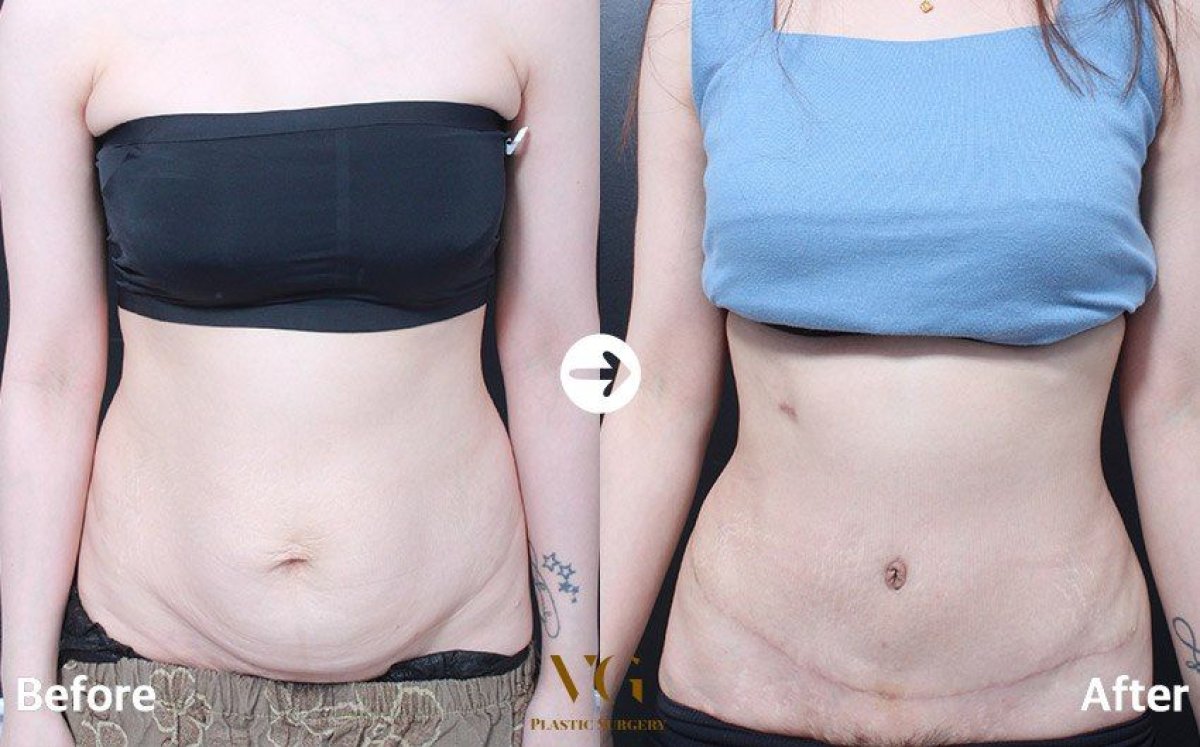 Resultados de abdominoplastia y liposucción antes y después en VG Plastic Surgery, abdomen plano