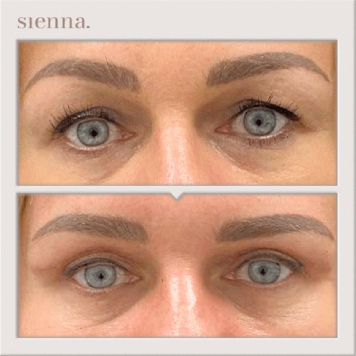 نتائج شد الوجه قبل وبعد في Sienna Clinic، تجديد منطقة حول العينين