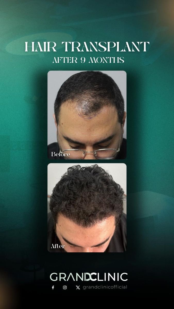 Résultats avant et après greffe de cheveux DHI à Grand Clinic, 9 mois après