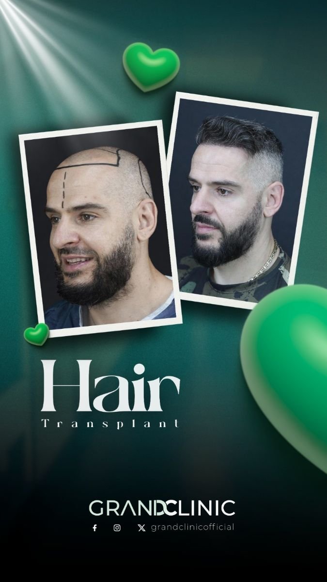 نتيجة قبل وبعد زراعة الشعر DHI في Grand Clinic، استعادة خط الشعر لمريض ذكر