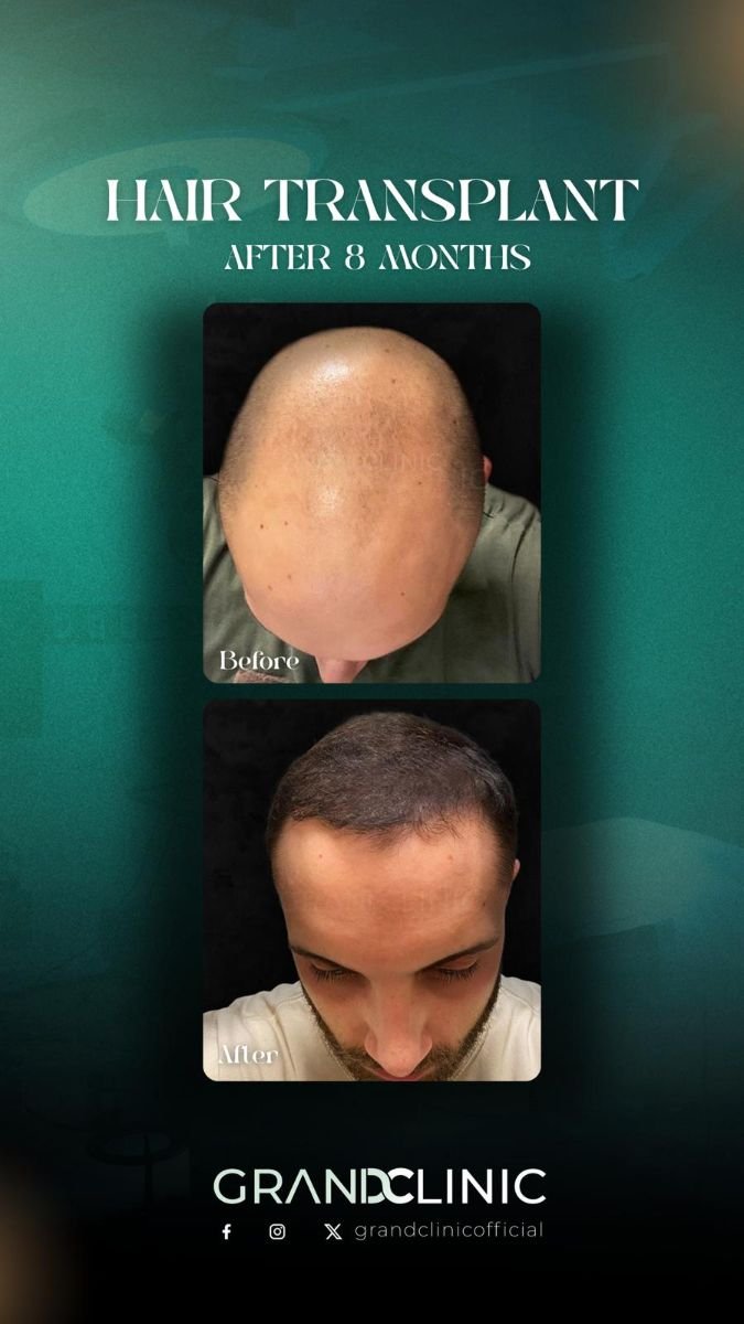Résultat avant/après greffe de cheveux DHI à Grand Clinic, 8 mois, ligne capillaire plus dense