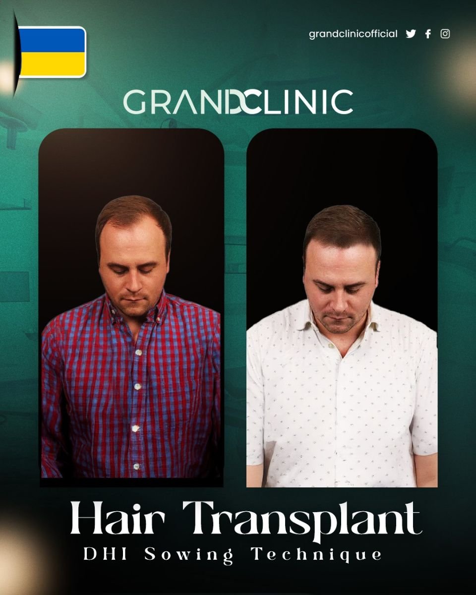 Результаты до и после DHI пересадки волос в Grand Clinic, видимое увеличение густоты