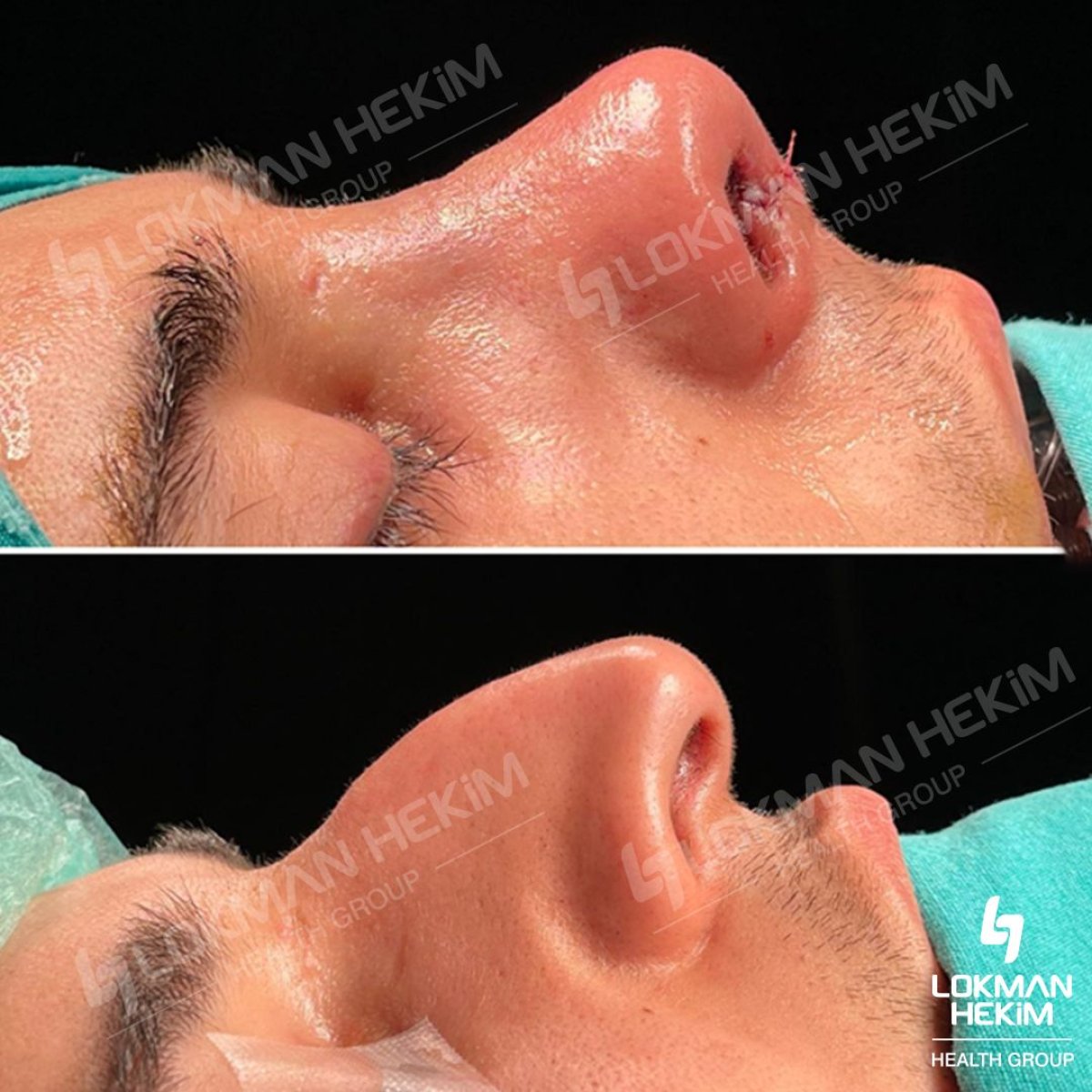 Before and after open rhinoplasty results at Lokman Hekim Istanbul Hospital, nose reshaping