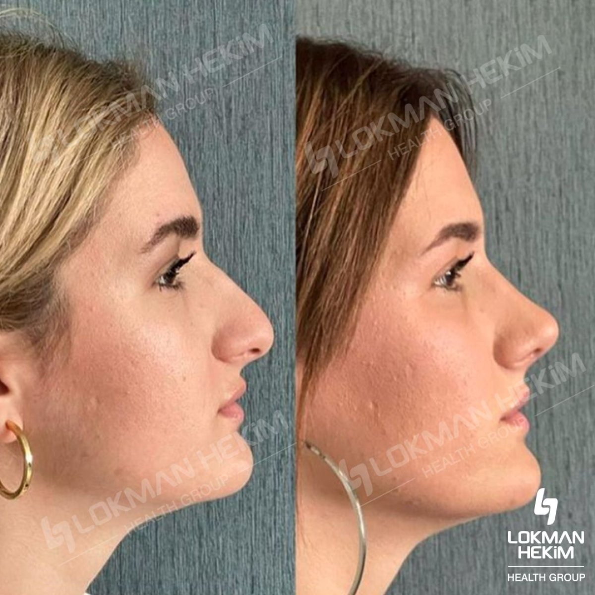 Résultats avant et après rhinoplastie ouverte à Lokman Hekim Istanbul Hospital, remodelage du nez