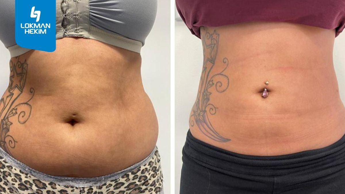 Before and after liposuction 3 body areas at Lokman Hekim Istanbul Hospital, visible contour result