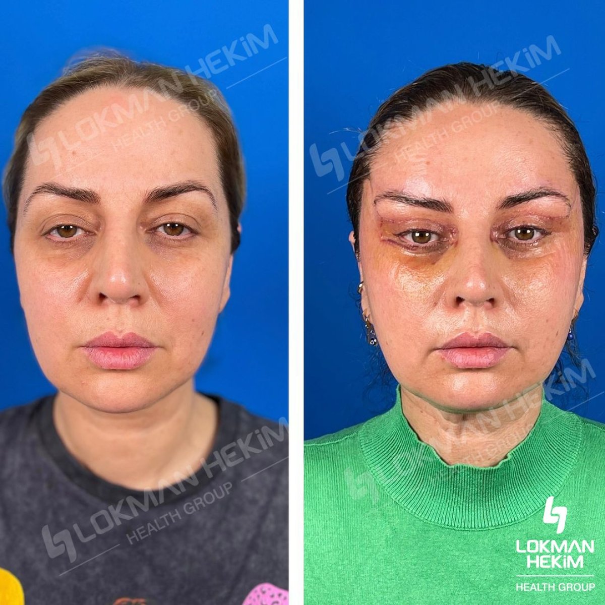 Before and after lower eyelid blepharoplasty results at Lokman Hekim Istanbul Hospital