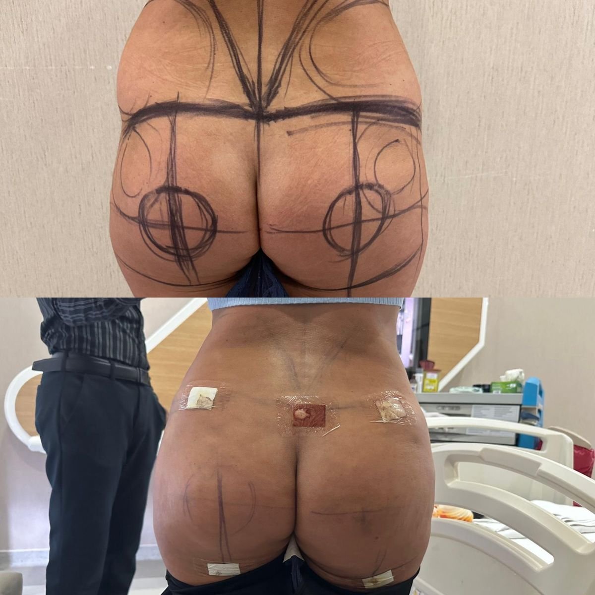 Efekty przed i po Brazilian Butt Lift w Lokman Hekim Istanbul Hospital, poprawiony kontur