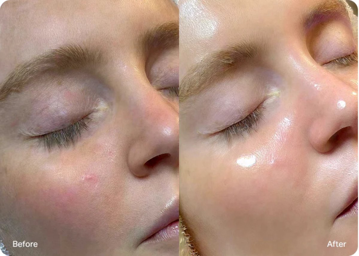 Before and after red light therapy results – improved facial skin texture and radiance