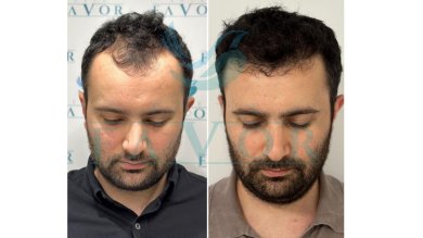 Standard Hair transplant (3000 Grafts) All Included - photo 5