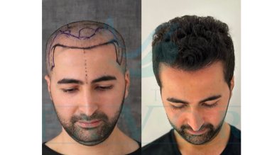 Standard Hair transplant (3000 Grafts) All Included - photo 4