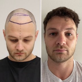 Standard Hair transplant (3000 Grafts) All Included - photo 6