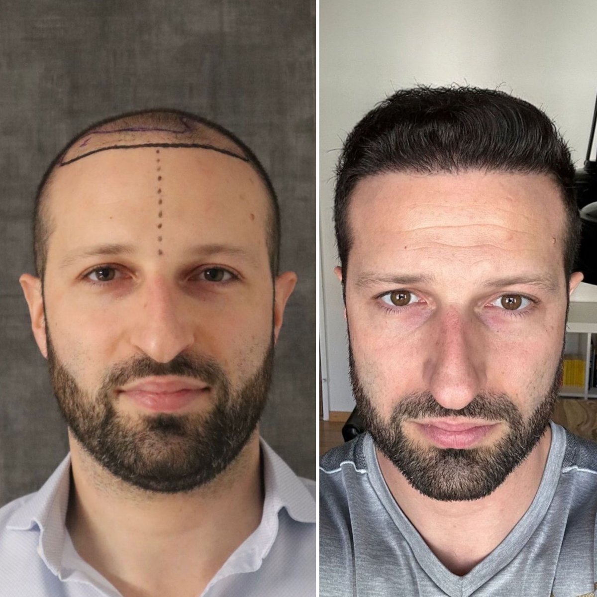 Результат пересадки волос до и после в Este Favor Hair Transplant Center, восстановленная линия волос