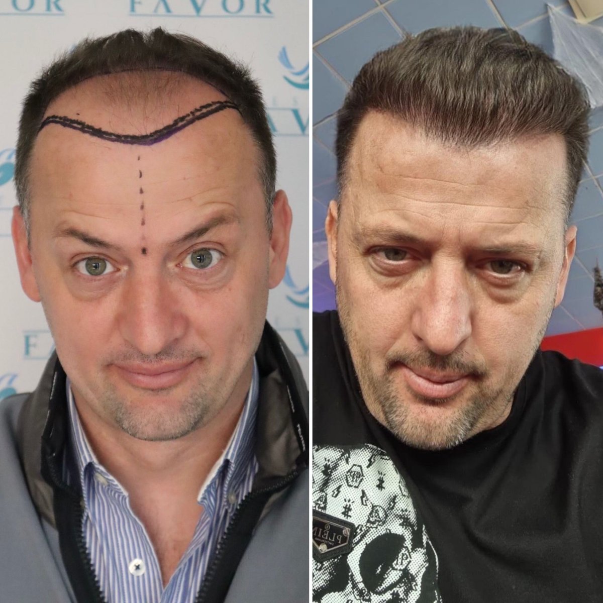 Before and after hair transplant result at Este Favor Hair Transplant Center, restored hairline