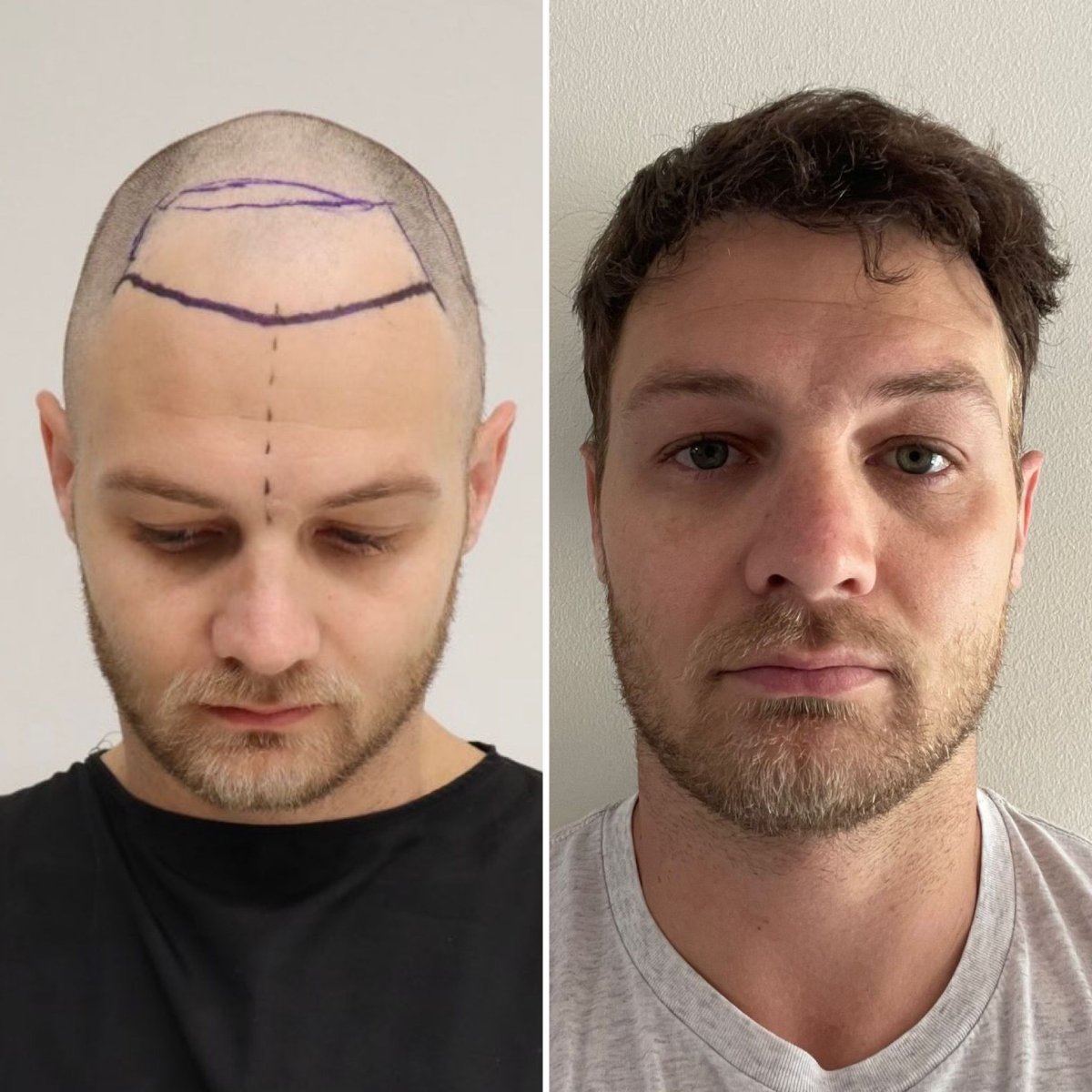 Resultados de trasplante capilar antes y después en Este Favor Hair Transplant Center, línea restaurada