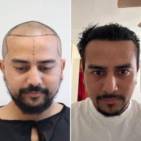 Standard Hair transplant (3000 Grafts) All Included - photo 4