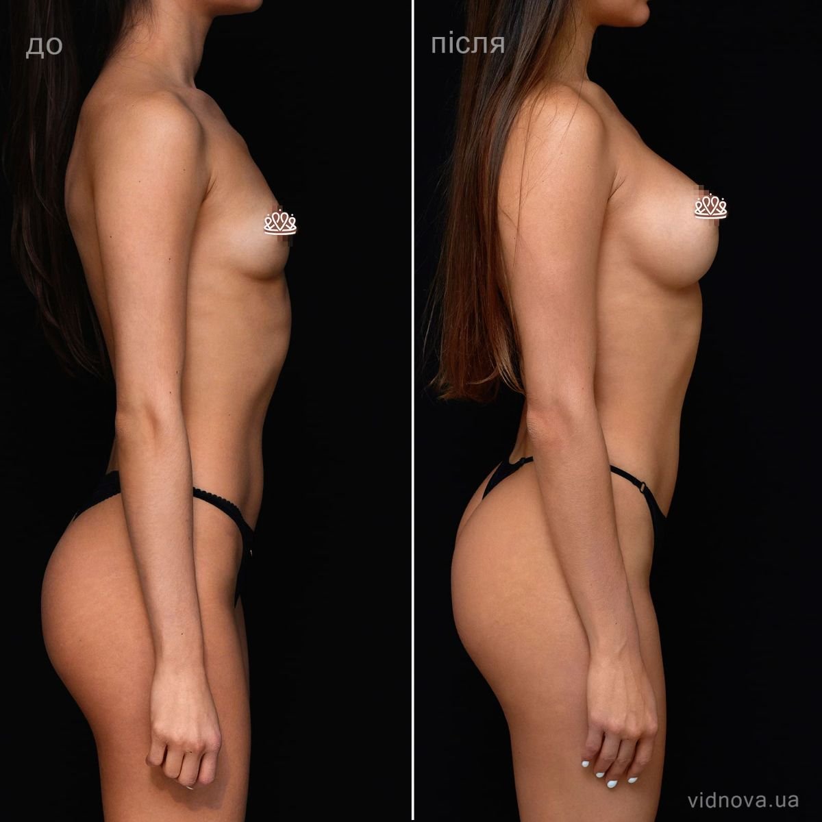 Before and after mammoplasty results at Vidnova Clinic – enhanced breast shape and volume