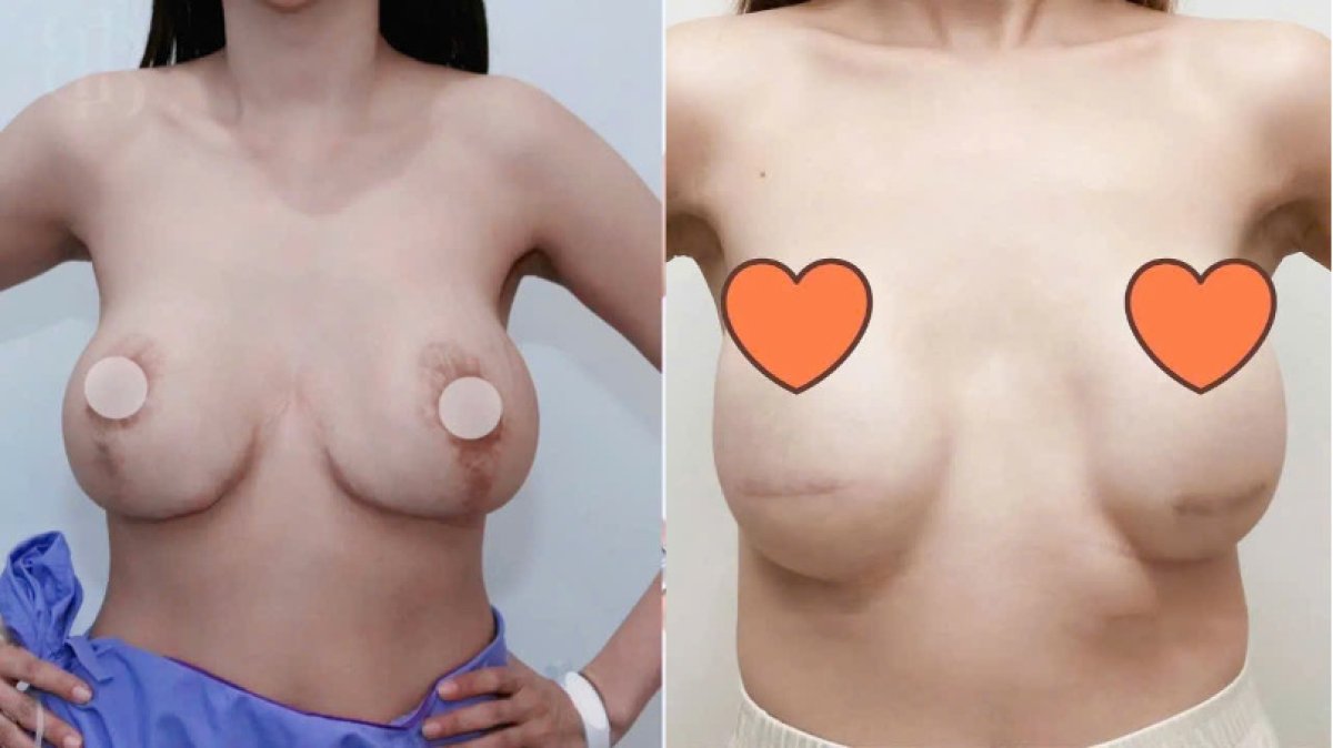 Before and after breast lift results – improved breast shape and contour after surgery