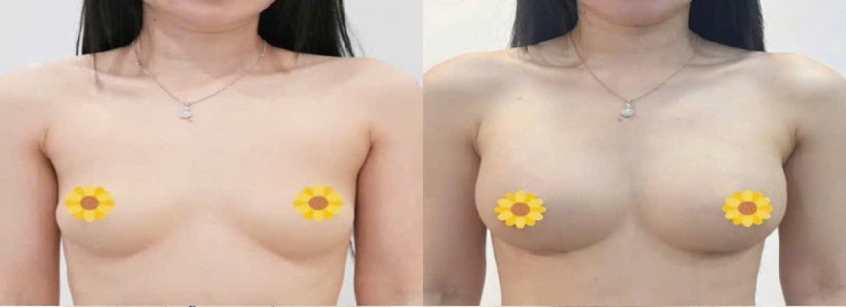 Before and after breast augmentation results – enhanced breast volume and contour