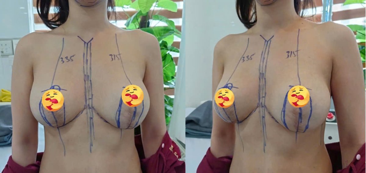 Before and after breast augmentation results, improved breast shape and symmetry