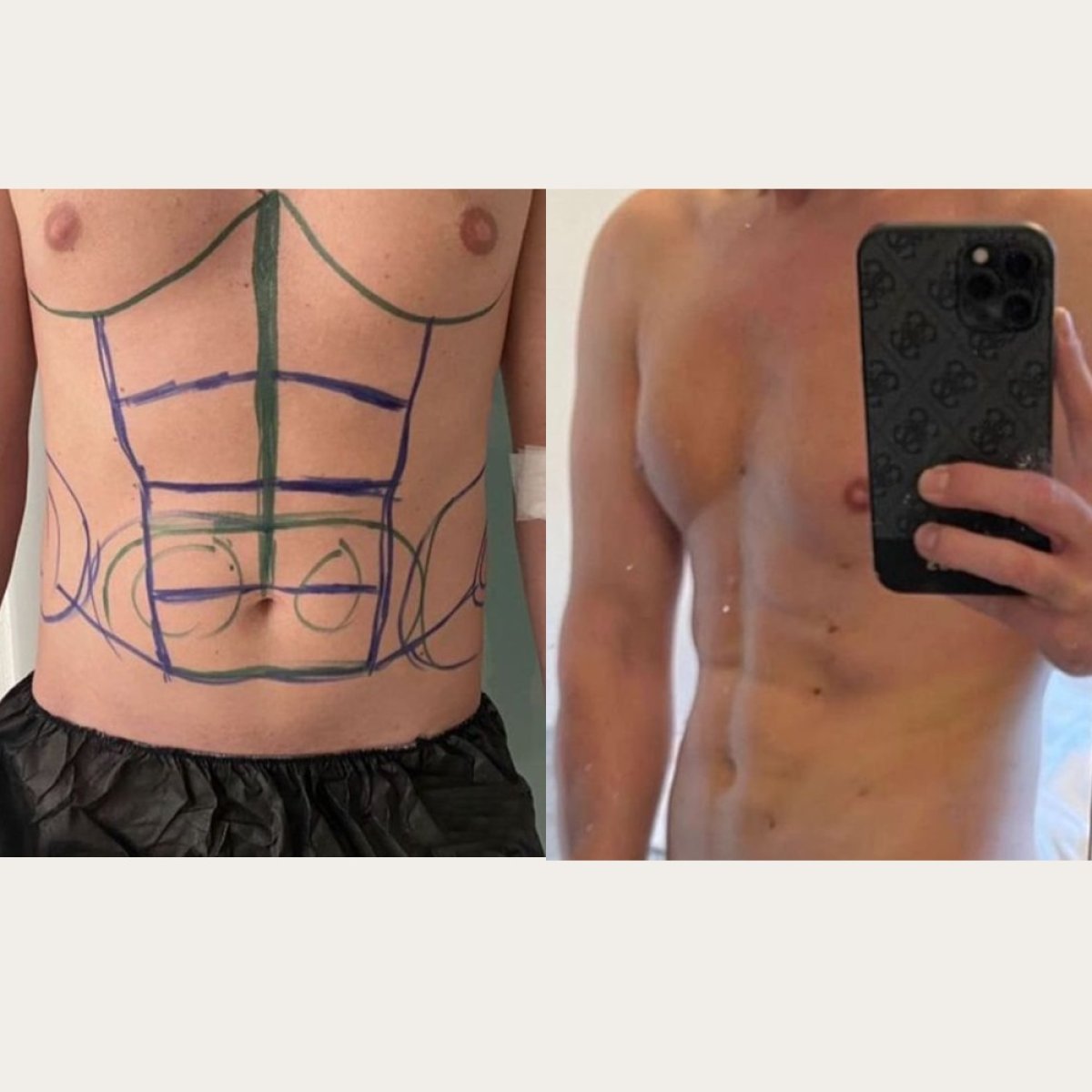 Resultados antes y después de marcación abdominal en Lokman Hekim Istanbul Hospital, abdominales
