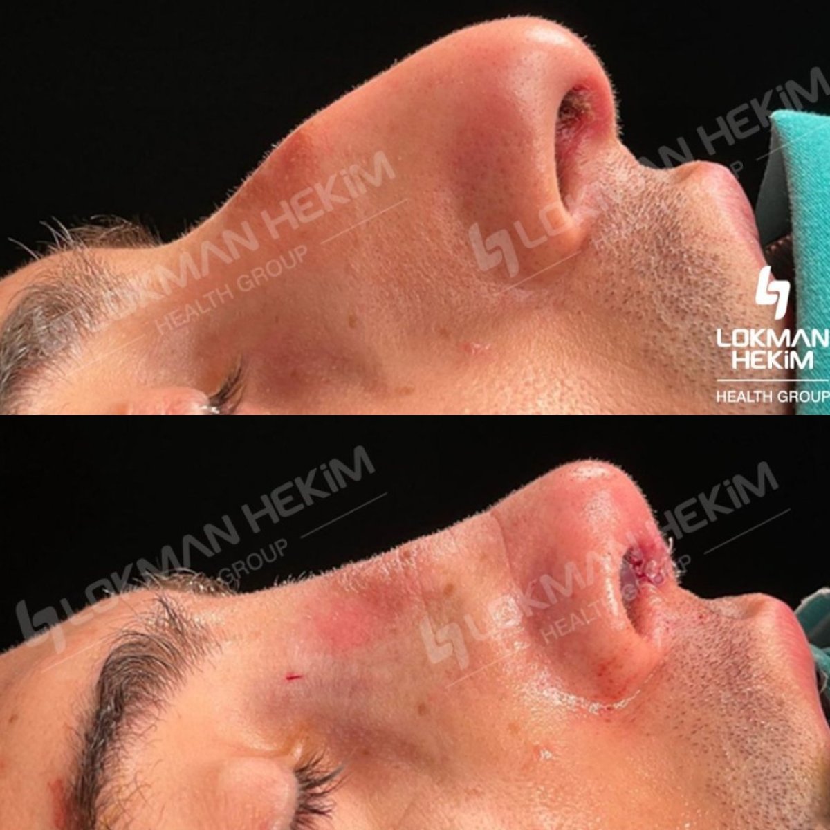 Résultats avant et après rhinoplastie de la pointe au Lokman Hekim Istanbul Hospital