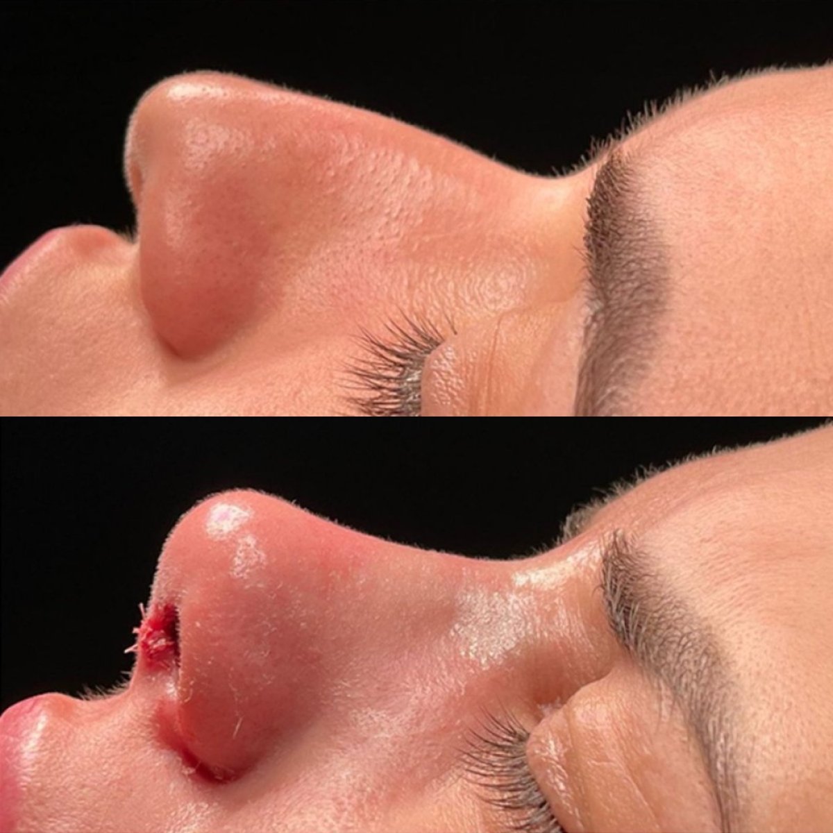 Resultados antes y después de rinoplastia de punta en Lokman Hekim Istanbul Hospital