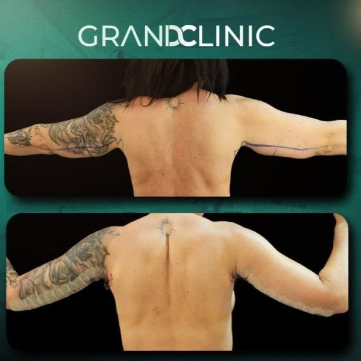 Before and after arm lift (brachioplasty) results at Grand Clinic, improved arm contour