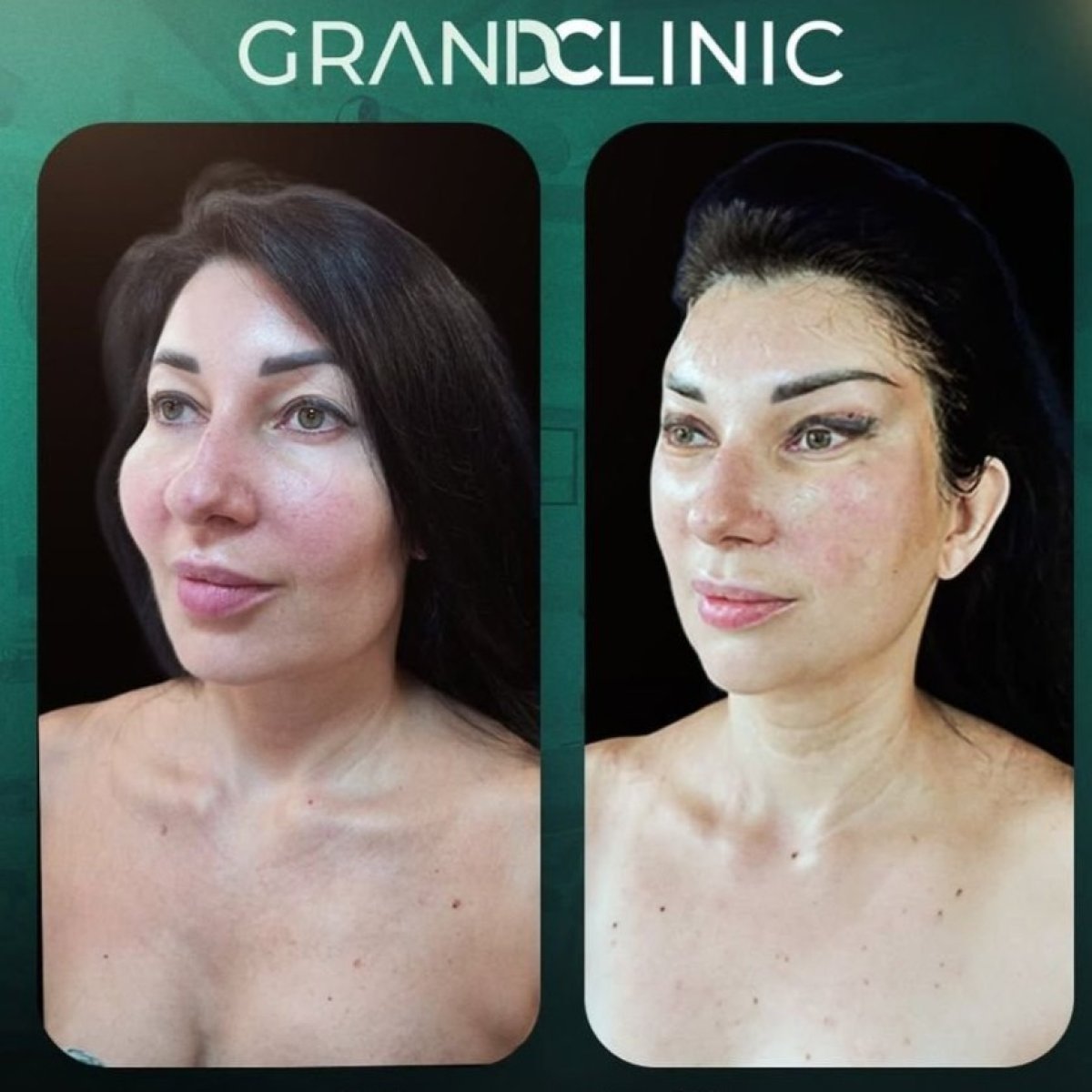 Результаты феминизирующей пластики лица до и после в Grand Clinic – мягкие черты лица
