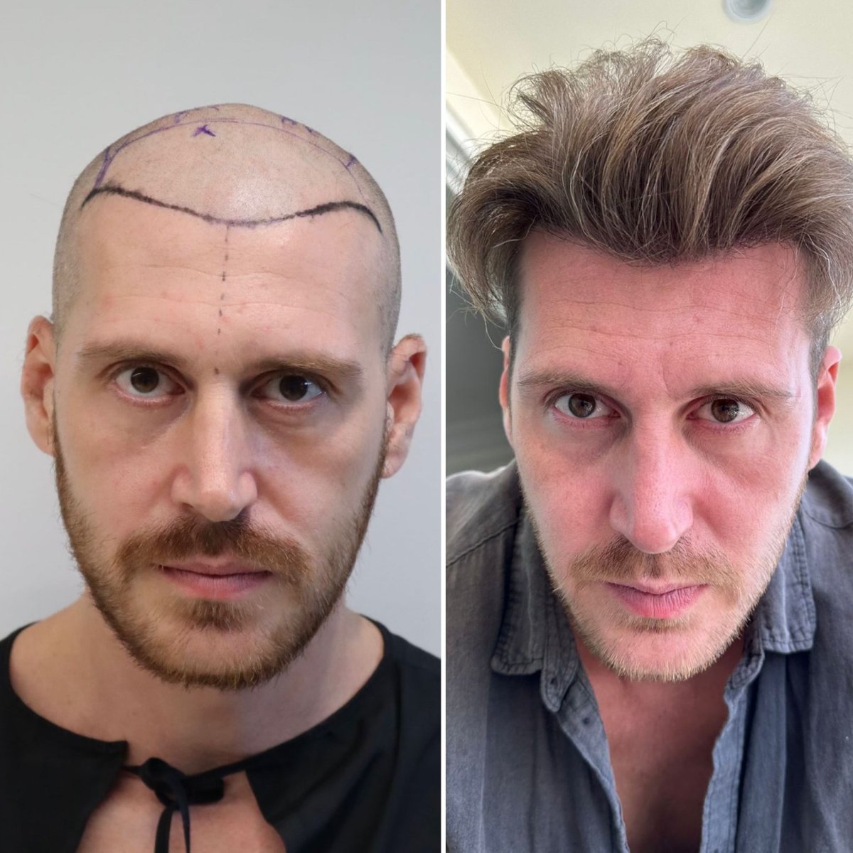Before and after hair transplant results at Este Favor Hair Transplant Center, restored hairline