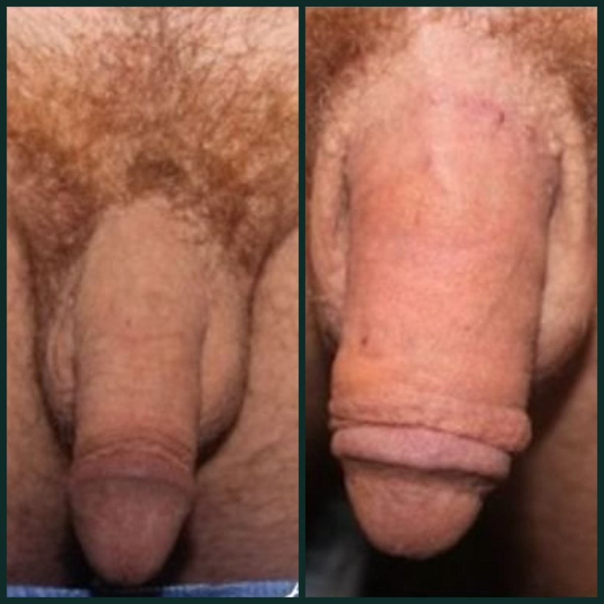 Vorher-nachher-Ergebnis Penis-Filler bei Grand Clinic – sichtbare Umfangsvergrößerung