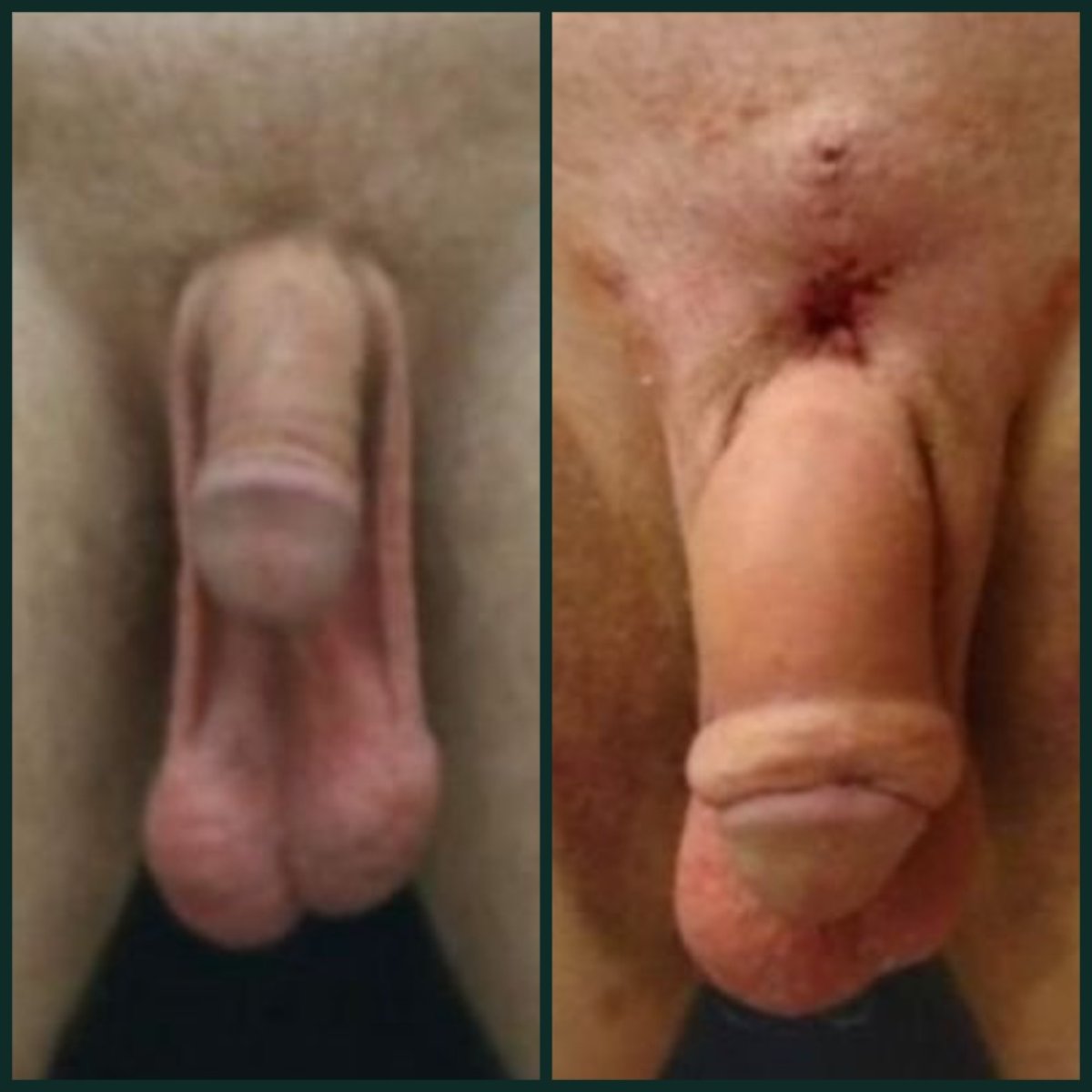 Vorher-nachher-Ergebnis Penis-Filler bei Grand Clinic, sichtbare Vergrößerung