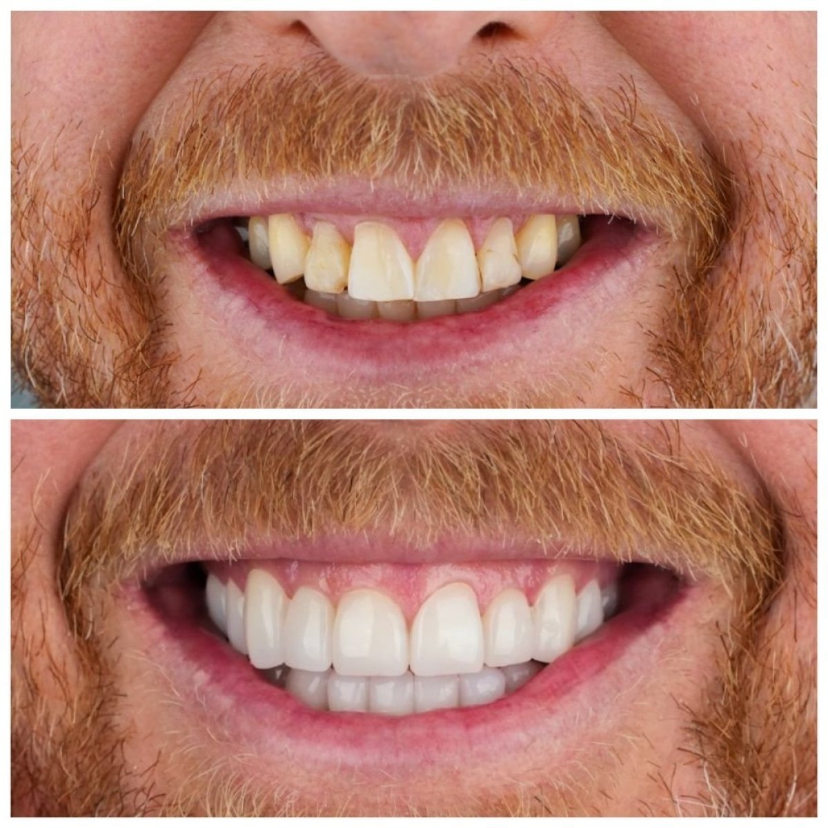 Before and after dental crown installation at Nifa Dent International, smile makeover result