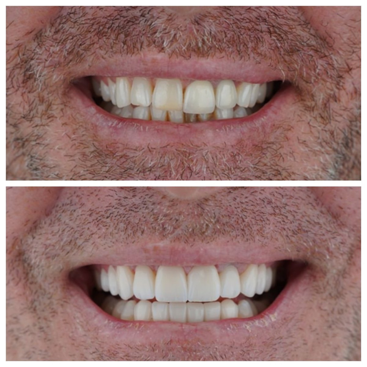 Before and after dental crown installation results at Nifa Dent International, improved smile