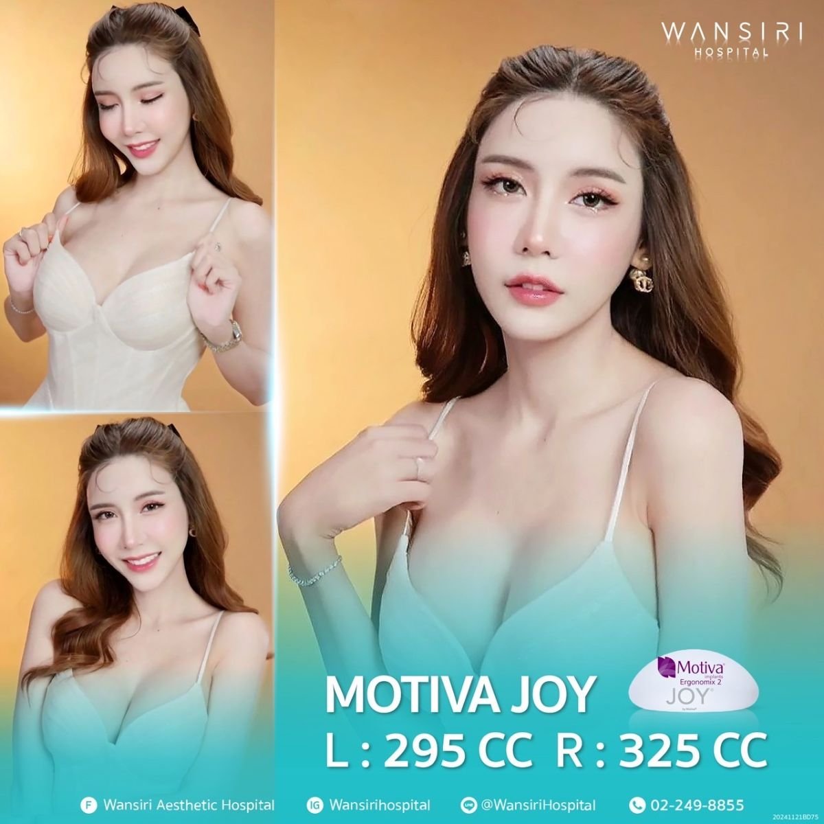 Powiększanie piersi implantami Motiva Joy w Wansiri Hospital, naturalny efekt