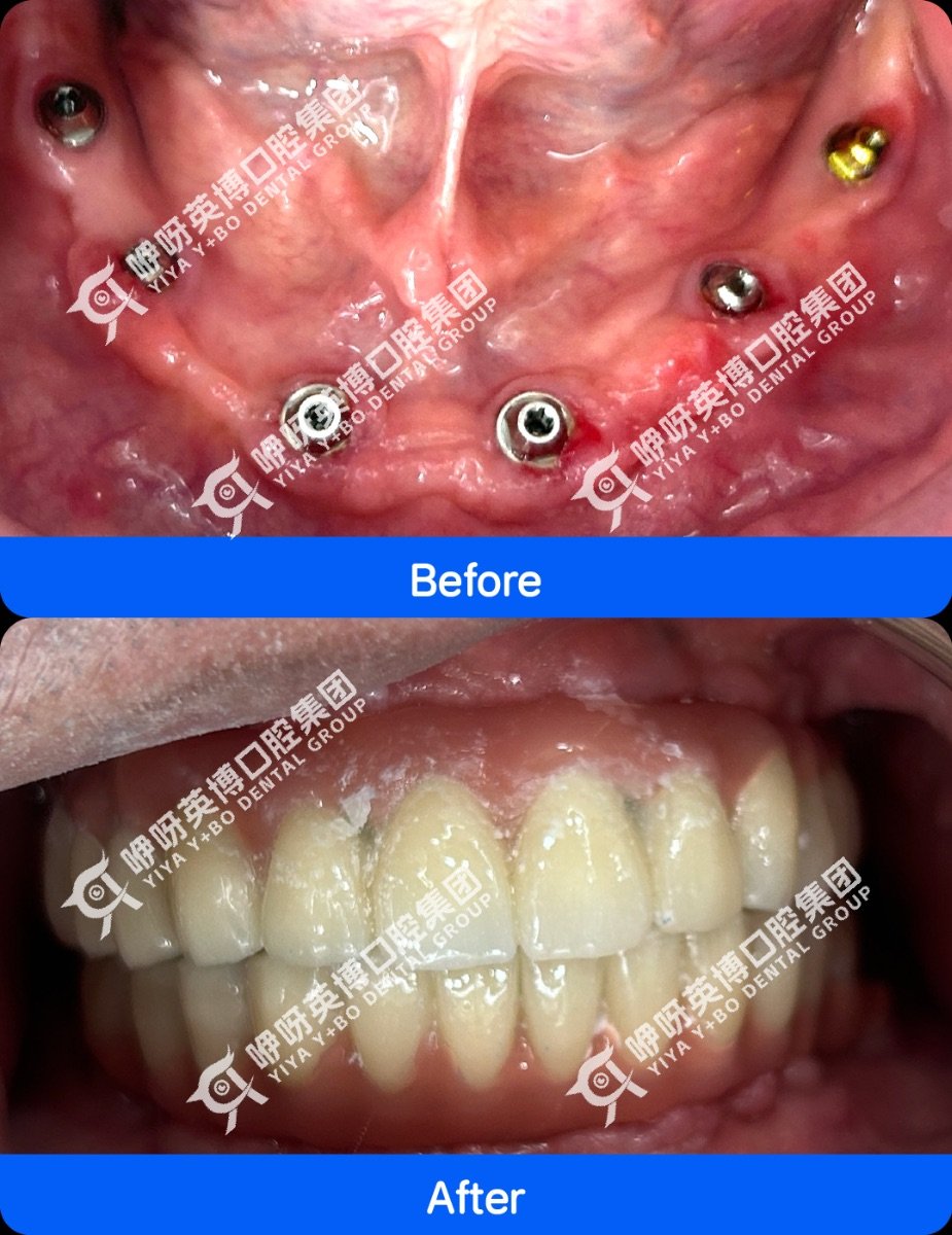 Before and after dental implant results at Wuhan Yiya Simei Dental Hospital, restored smile