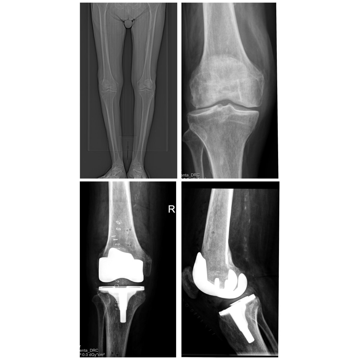 Résultats radiographiques avant et après prothèse du genou à la clinique Dr Papadopoulos