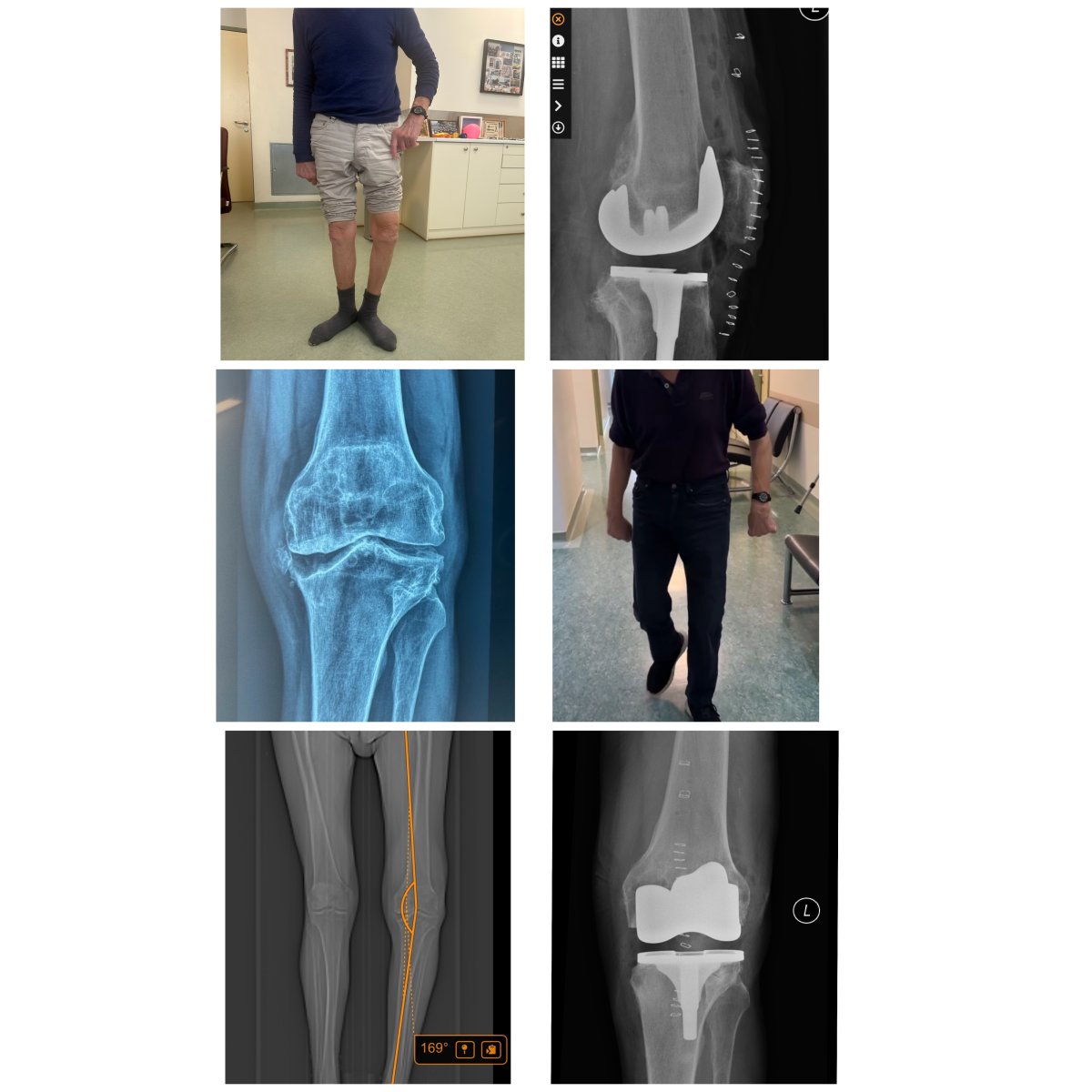 نتائج قبل وبعد استبدال الركبة في عيادة Dr Andreas Papadopoulos للطب الرياضي